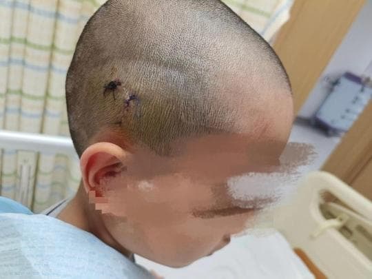 惊！孩子滑一跤 竟摔到脑出血