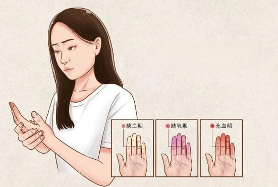 女生手指"冻白了" 网友："雷诺现象" 建议去医院！