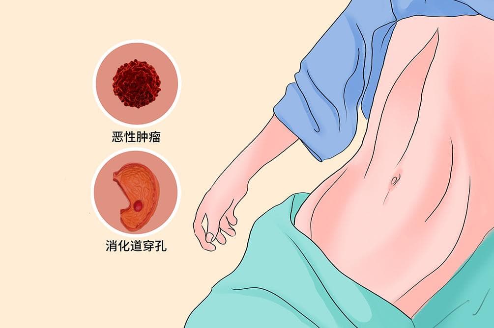 舟状腹：病因、症状、诊断与治疗全解析