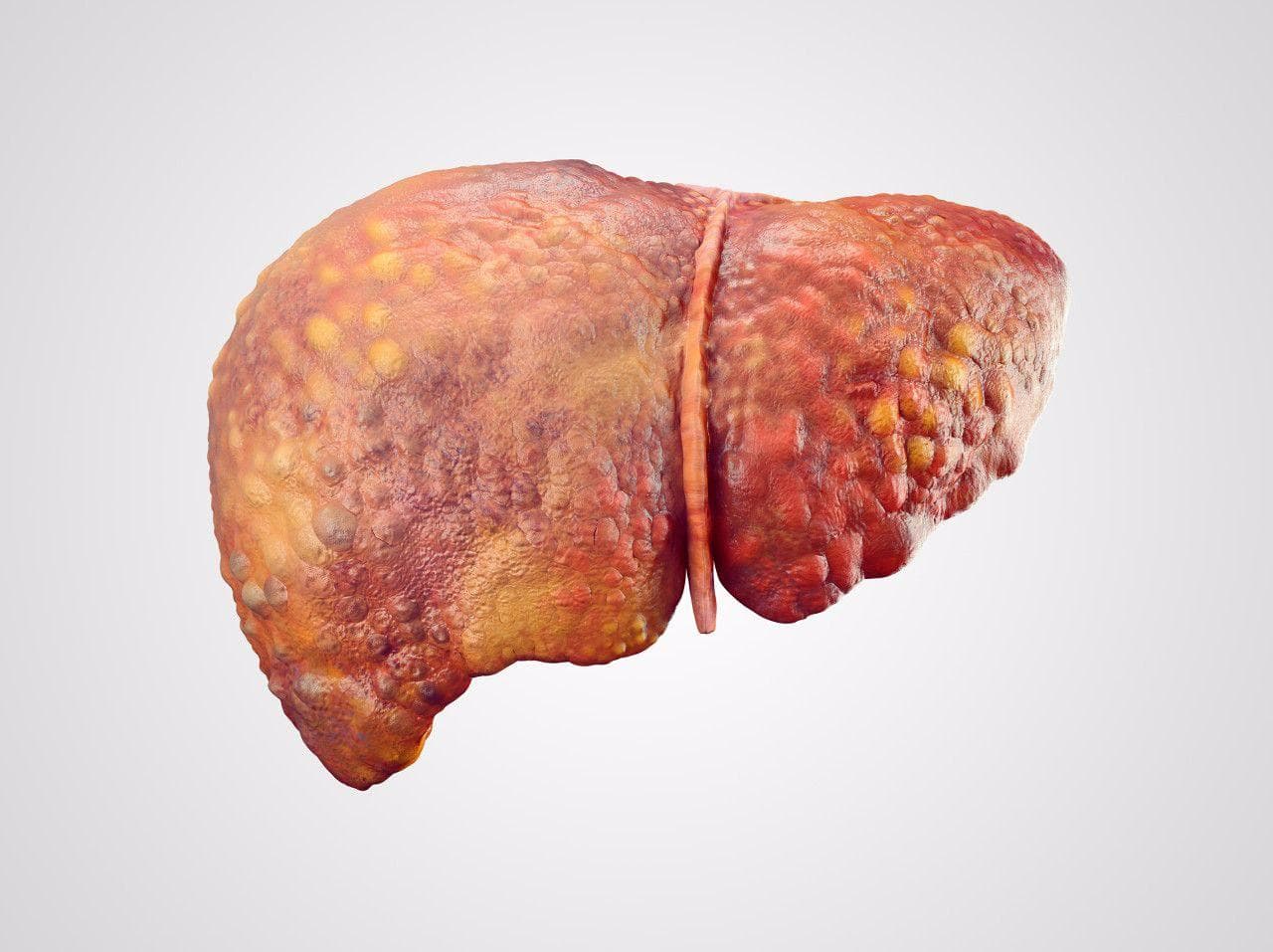慢性活动性肝炎的临床表现及症状