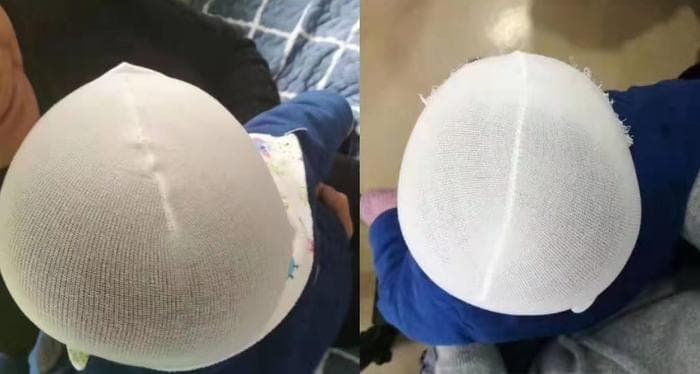 婴儿头型矫正，每天戴23小时头盔，请别让孩子为你的愚蠢买单好么