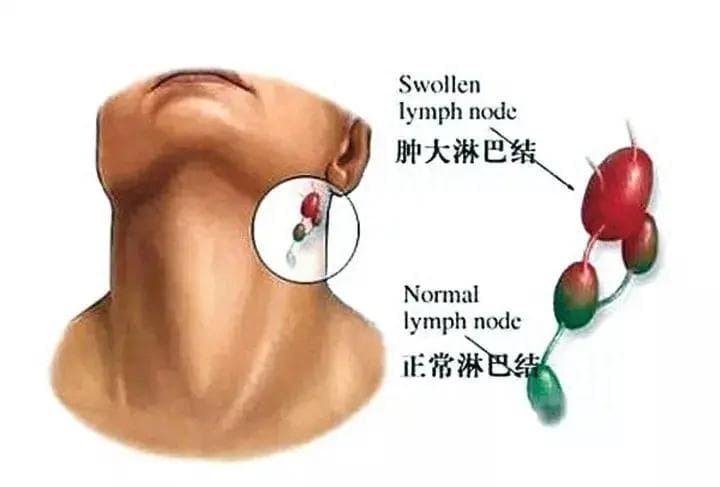 淋巴结肿大怎么办？是这6原因引起的！4个治疗方法，守护你健康