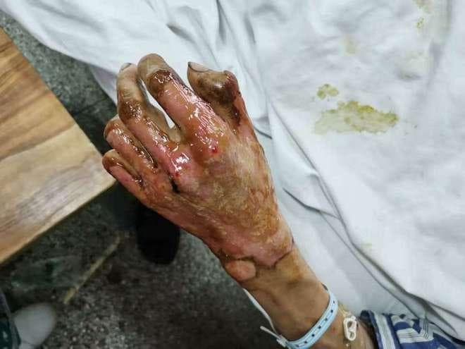 烫伤后的关键五步，你第一步就错了！