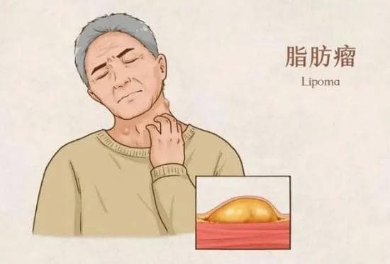 脂肪瘤是常见良性肿瘤，可手术切除，术后需预防复发