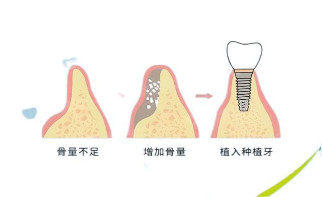 种植牙好不好？和传统修复方式有什么区别？