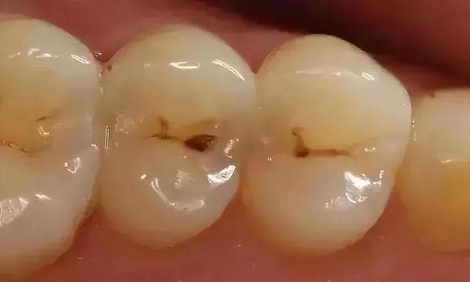 其实，补牙并不可怕，但要注意用对方式，用牙膏就能补上牙洞？