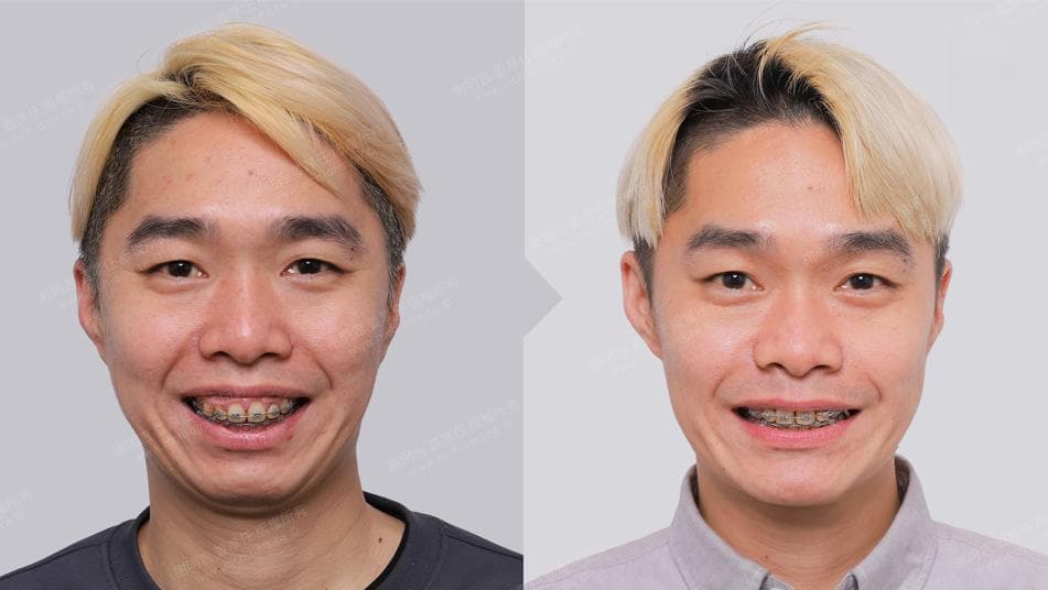 MMA手术成功治愈中度睡眠呼吸中止症，患者AHI从22.9降至2.7
