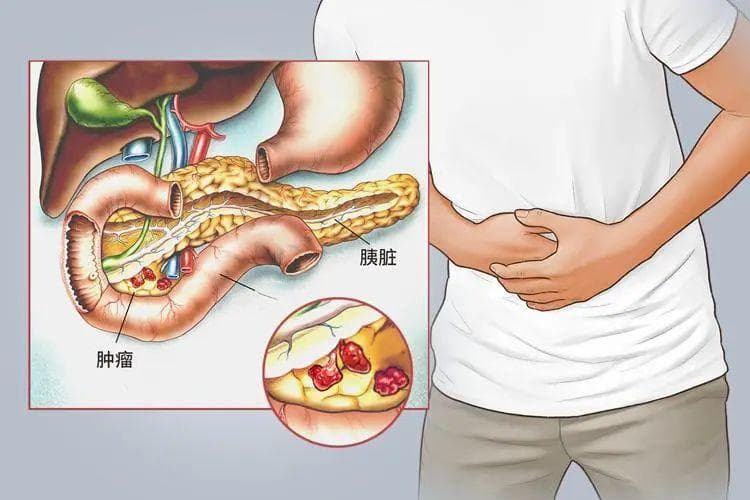 保护胰腺健康，有些食物要少吃