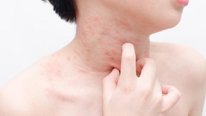 过敏性紫癜的诊断标准详解