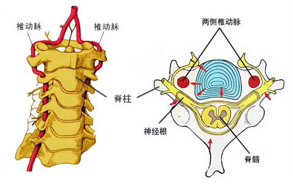 椎动脉型颈椎病的正骨治疗
