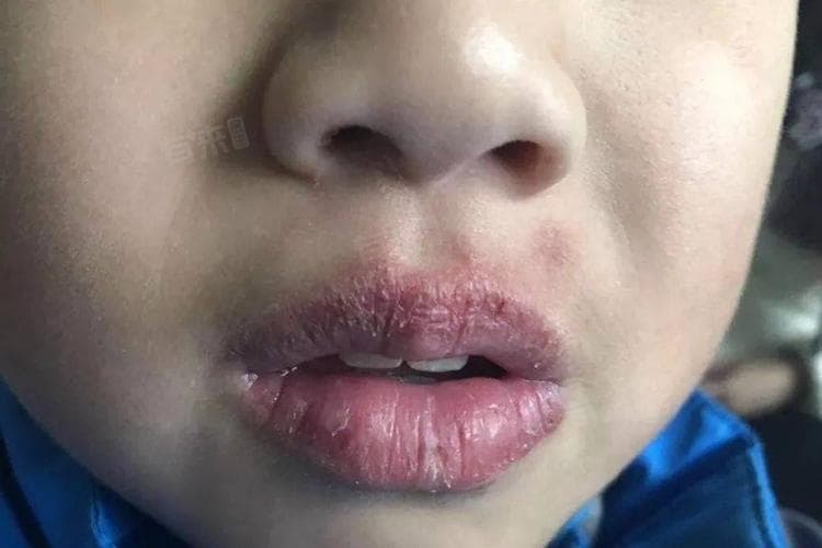 咬破嘴唇怎么防止口腔溃疡