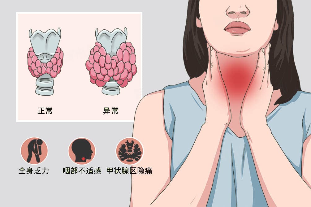 桥本甲状腺炎一定要治疗吗
