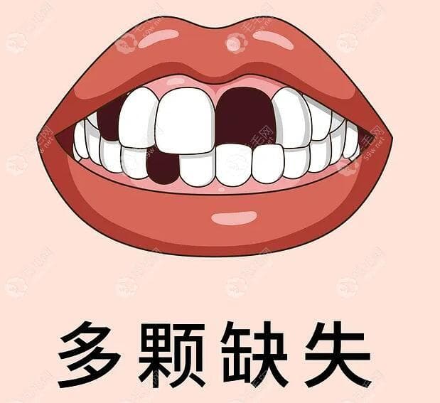 缺牙的三种修复方式：活动义齿、固定假牙、种植牙