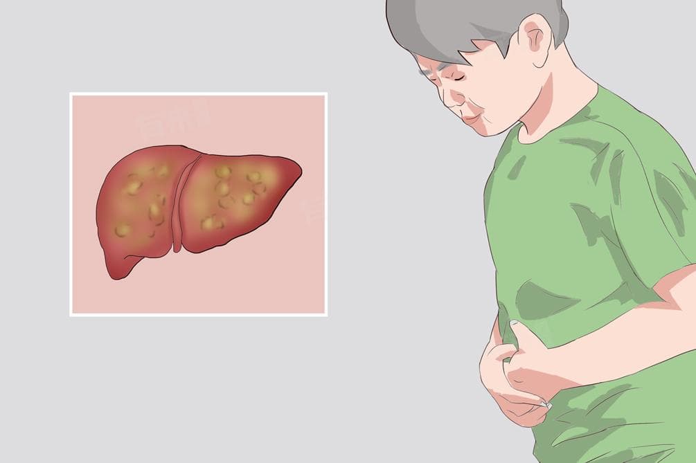 肝硬化的诊断标准与治疗方法