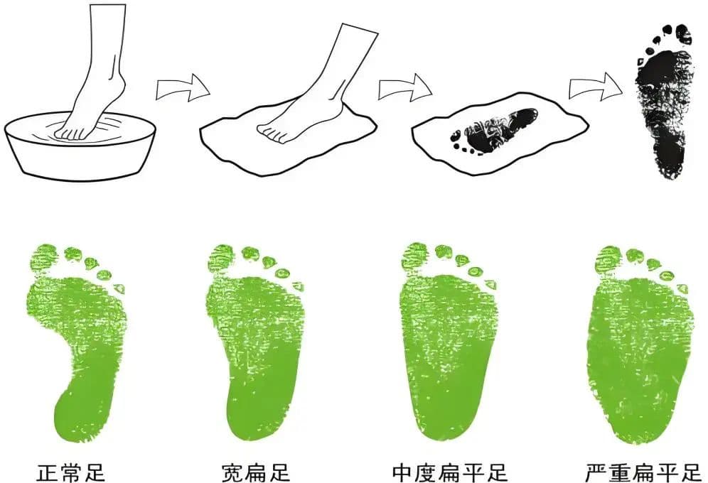 矫形鞋垫竟然能治娃的“弓腰驼背”？