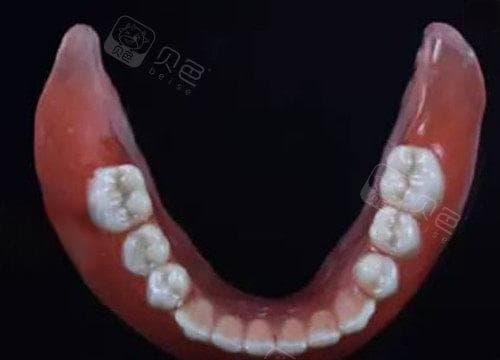 牙界新宠！吸附式假牙是怎么一回事？分析吸附式假牙工作原理/特点/适应症/制作流程