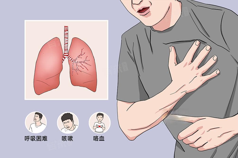 左肺上叶钙化灶：病因、症状与治疗全解析