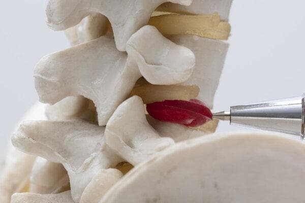 腰椎椎管狭窄和腰椎间盘突出区别