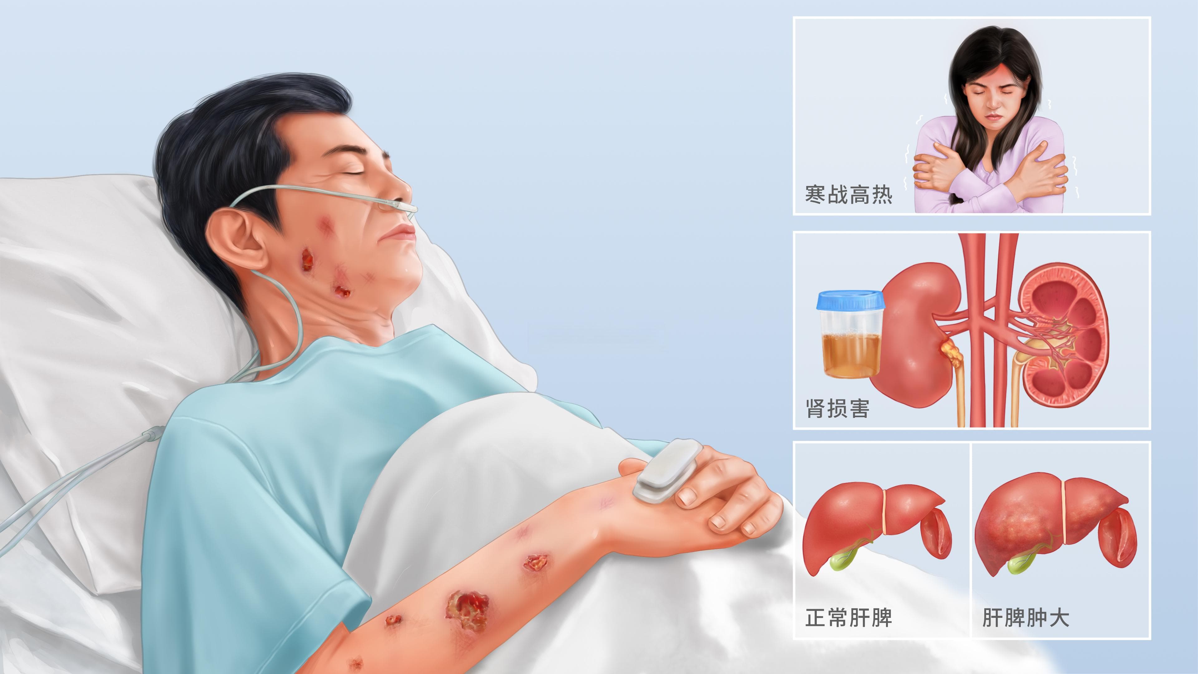 脓毒症：一种致命的全身性炎症反应综合征