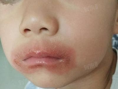 孩子嘴唇周围发红、老舔嘴怎么办