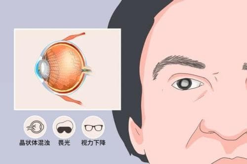 新农合老年人做白内障手术费用详解：报销政策与免费治疗方案