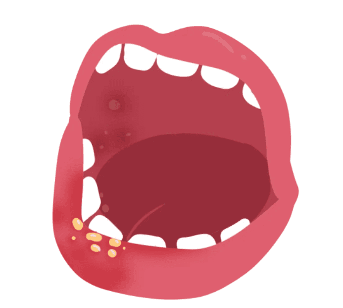 灼口综合征：揭秘口腔烧灼之谜，寻找缓解之道