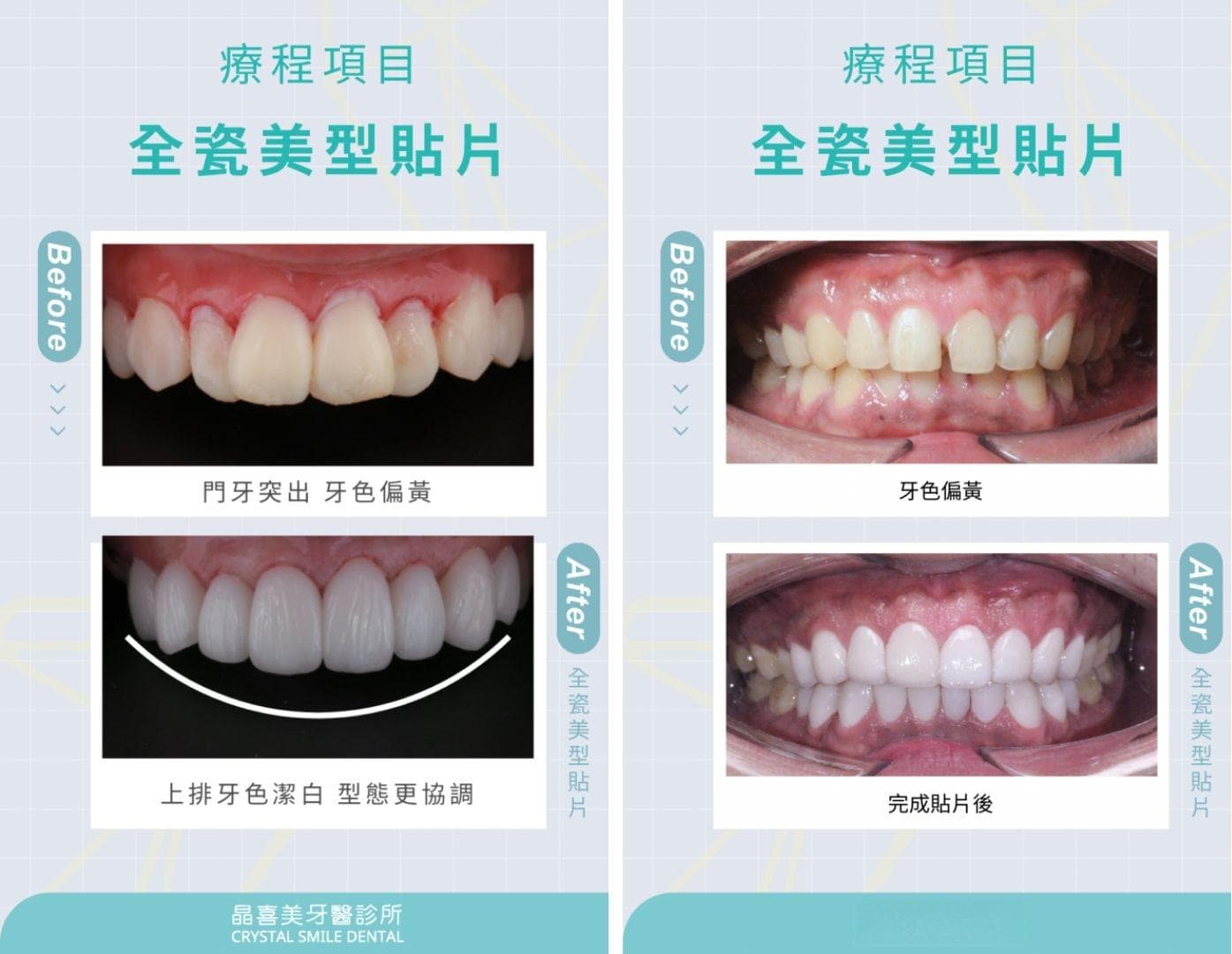 8种牙齿美白方式大PK！哪种牙齿美白效果最好？牙齿美白安全吗？