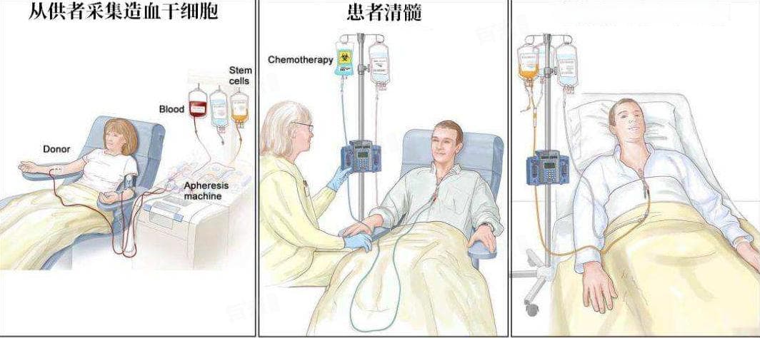 骨髓移植大概需要多少钱