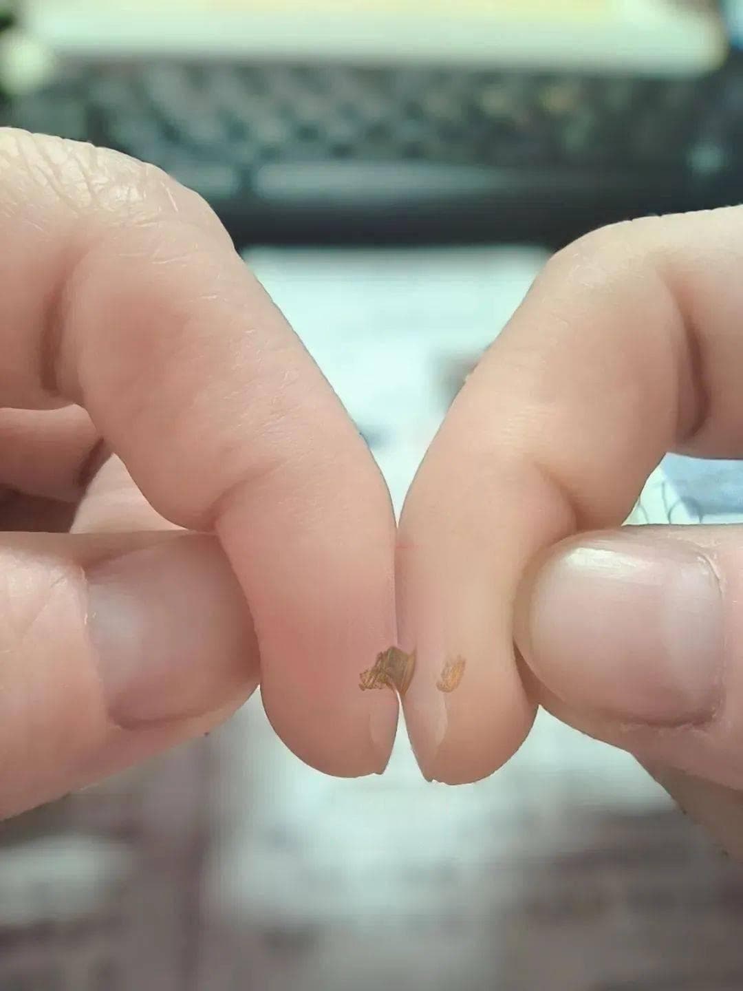 体内有疾，指甲先知？指甲出现6种异常可能是疾病预警