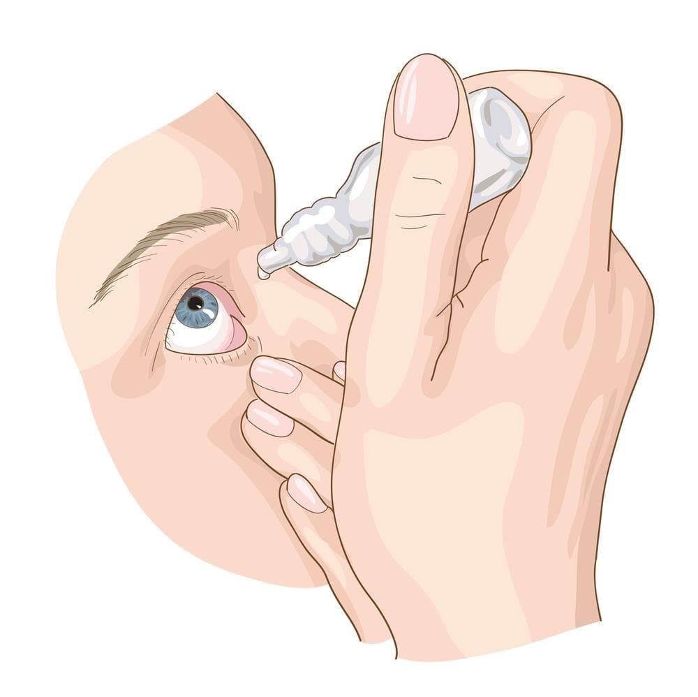 怎么预防霰粒肿复发