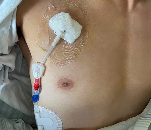 胸腔闭式引流术：呼吸的守护者