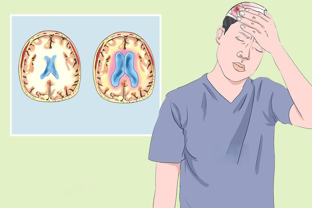 脑积液是什么病，能治愈吗