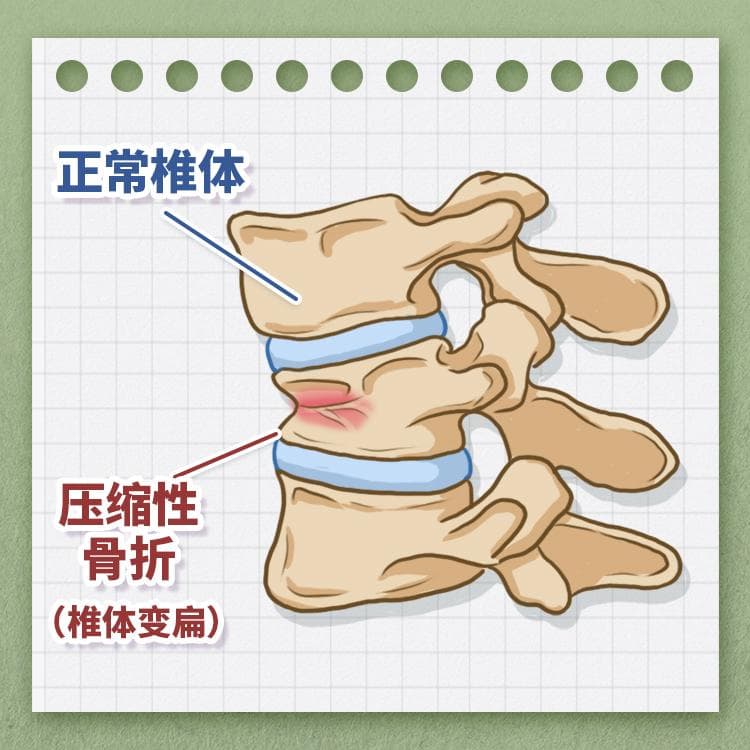 中老年人的隐形危机：骨质疏松性椎体压缩骨折的成因、诊断与应对策略