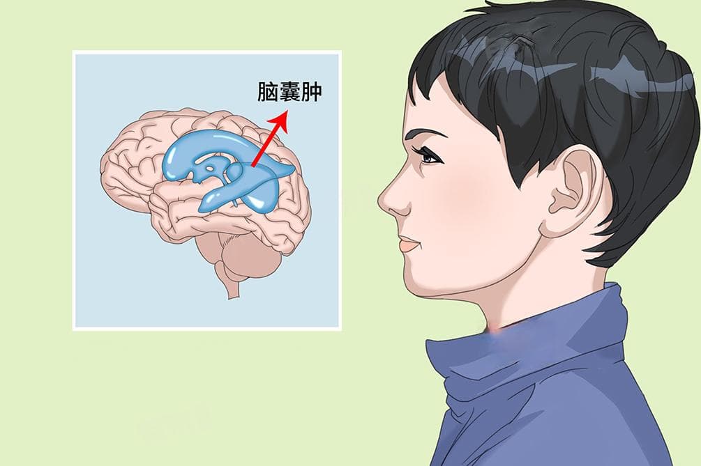 脑子里有囊肿严重吗