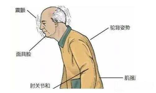 什么是锥体外系反应？
