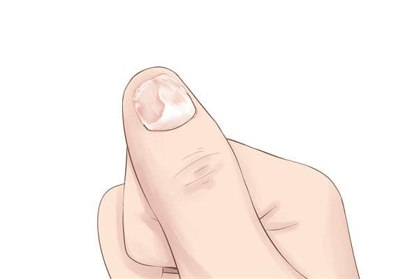 甲沟炎最佳外用药是什么 治甲沟炎外用药使用方法