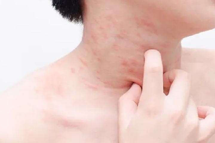 荨麻疹的症状表现全解析