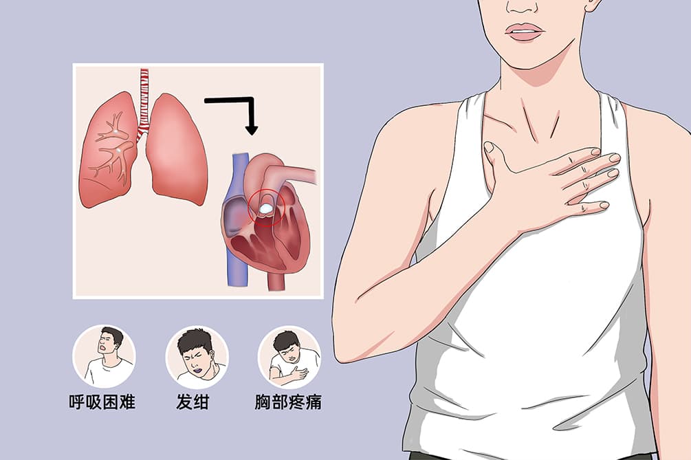 空气栓塞：病因、症状、诊断与治疗全解析