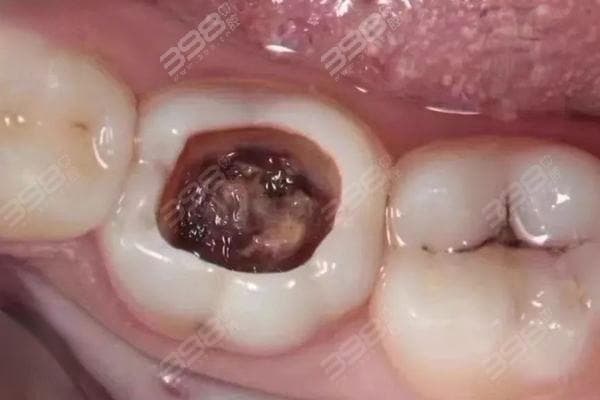怎么判断深龋到没到神经？到哪种程度需要做根管
