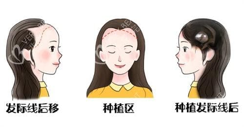 后枕部毛囊不够多能植发吗？有一定挑战性但或许可以参考院方技术辅助改善