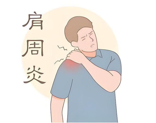 肩周炎来袭，是该“动”起来还是“静”养为佳？