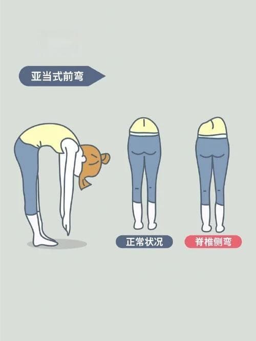 脊柱侧弯如何自我矫正保护？这份实用指南请收好