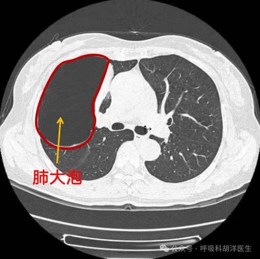 肺大泡影响肺功能，有些人需要终生用药，能做手术把它切除吗？