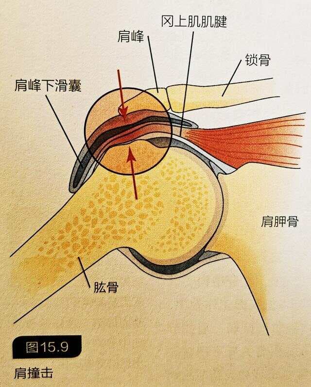 引体向上导致的肩袖损伤，应该如何预防