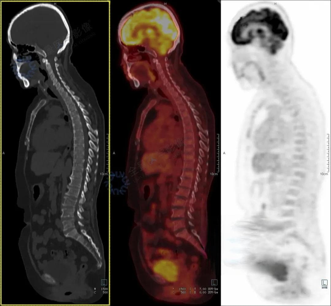 血液病中的「伪装高手」，看 PET/CT 如何揪出多发性骨髓瘤