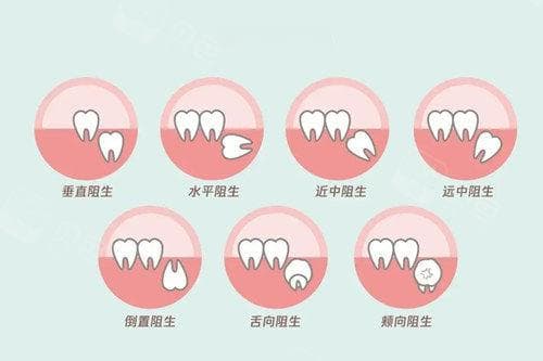 阻生智齿一定要拔吗？横生智齿不拔会把邻牙顶坏吗？