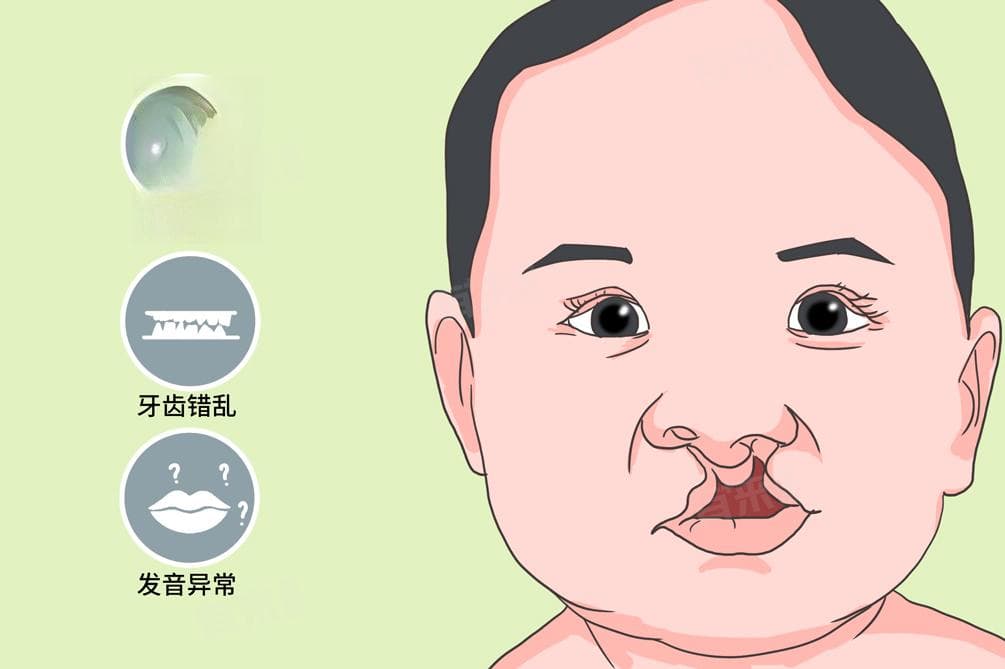 为什么会有兔唇？成因、预防与治疗方法全解析