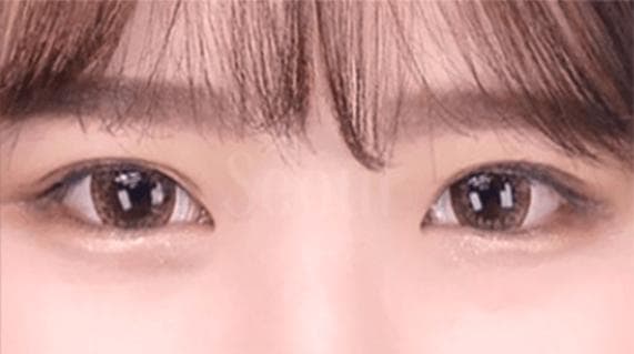 五合一隐痕手术：彻底解决眼袋问题的新选择