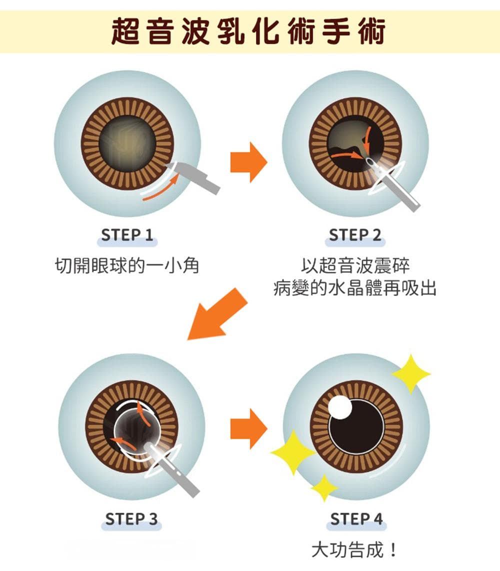白内障是什么？症状有哪些？常见白内障手术及原因一篇攻略！