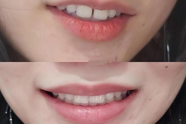 补牙后注意事项